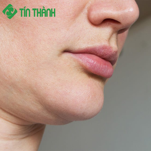 Phương pháp khắc phục cơ mặt chảy xệ Phương pháp khắc phục cơ mặt chảy xệ