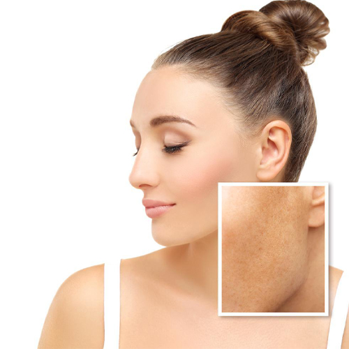 Máy trị nám laser toning giá bao nhiêu Máy trị nám laser toning giá bao nhiêu