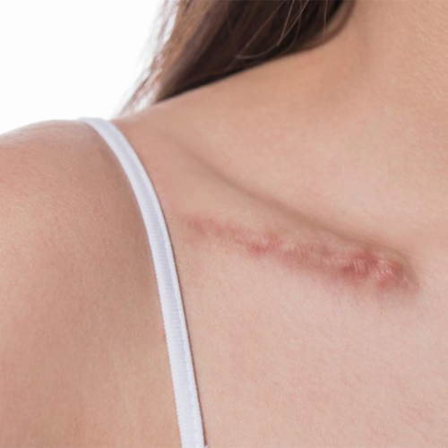 Máy trị sẹo hiệu quả nhất hiện nay Máy trị sẹo hiệu quả nhất hiện nay