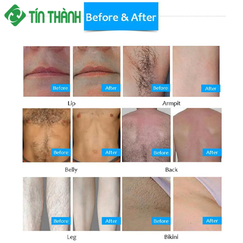Hình ảnh trước và sau điều trị bằng Máy triệt lông diode laser 808KK-1200 Hình ảnh trước và sau điều trị bằng Máy triệt lông diode laser 808KK-1200