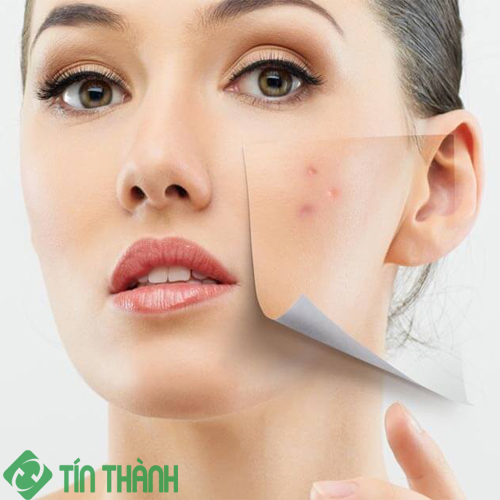 Bí quyết chăm sóc và phục hồi da hư tổn sau mụn Bí quyết chăm sóc và phục hồi da hư tổn sau mụn