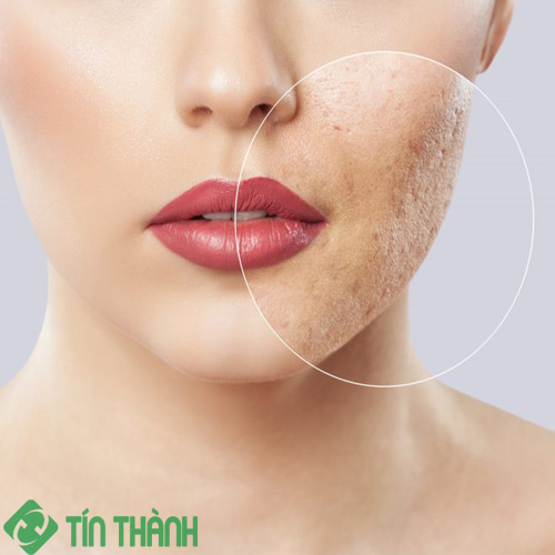 Bí quyết chăm sóc và phục hồi da hư tổn sau mụn Bí quyết chăm sóc và phục hồi da hư tổn sau mụn