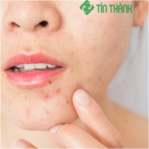 Bí quyết chăm sóc và phục hồi da hư tổn sau mụn Bí quyết chăm sóc và phục hồi da hư tổn sau mụn