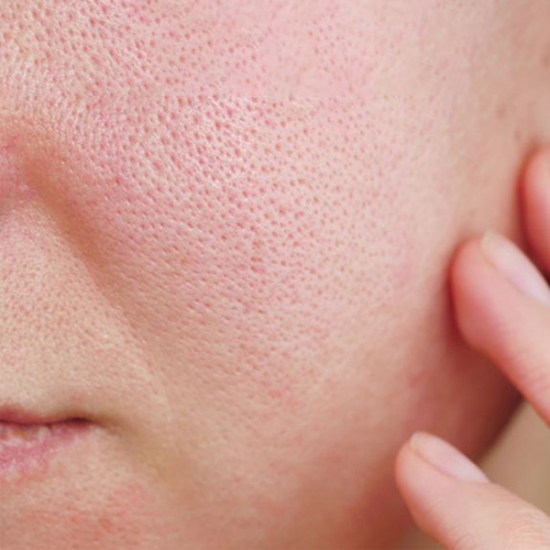 Se khít lỗ chân lông bằng laser có hiệu quả không ? Se khít lỗ chân lông bằng laser có hiệu quả không ?