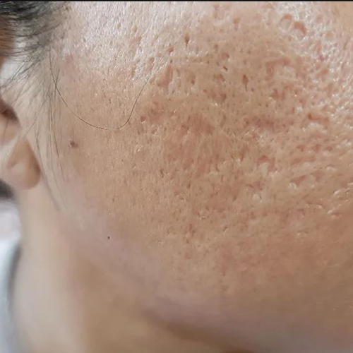 Sẹo rỗ có tự hết không và cách ngăn ngừa sẹo rỗ Sẹo rỗ có tự hết không và cách ngăn ngừa sẹo rỗ