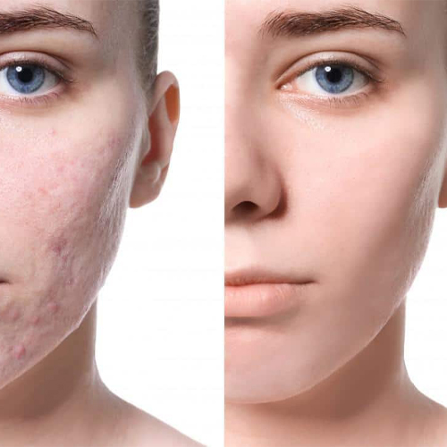 Sẹo rỗ có tự hết không và cách ngăn ngừa sẹo rỗ Sẹo rỗ có tự hết không và cách ngăn ngừa sẹo rỗ