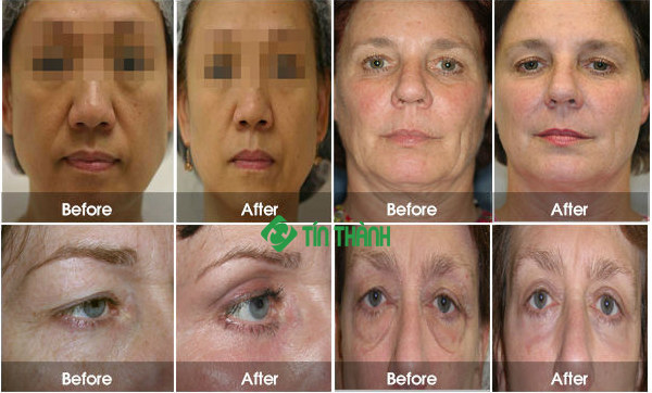 Hifu có thể sử dụng cho nhiều vùng da khác nhau mà không gây tác dụng phụ hay đau đớn Hifu có thể sử dụng cho nhiều vùng da khác nhau mà không gây tác dụng phụ hay đau đớn