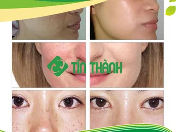 Công nghệ Picosecond laser là gì ?