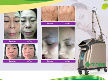 Máy laser picotech giá bao nhiêu và công dụng thế nào ?