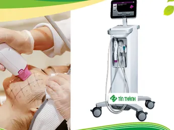 Kết quả nâng cơ bằng Thermage FLX giữ được bao lâu ?