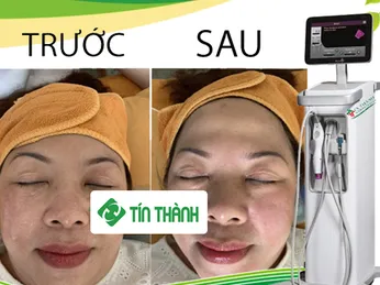 Công nghệ Thermage FLX là gì?