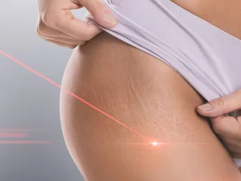 Điều trị rạn da bằng laser là gì và hiệu quả thế nào?