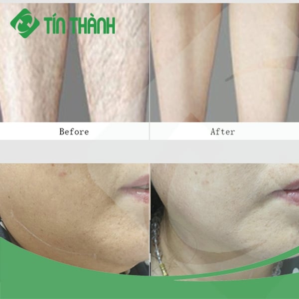 Máy triệt lông K3