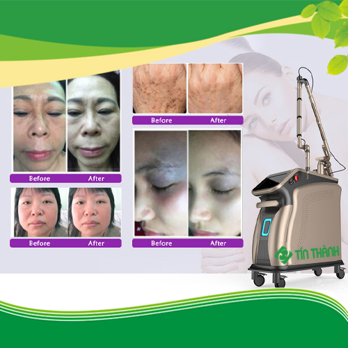 TOP 5 Máy Laser Thẩm Mỹ Tốt Nhất 2022 TOP 5 Máy Laser Thẩm Mỹ Tốt Nhất 2022