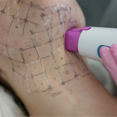 Công nghệ trẻ hóa da mặt mới nhất hiện nay Công nghệ trẻ hóa da mặt mới nhất hiện nay