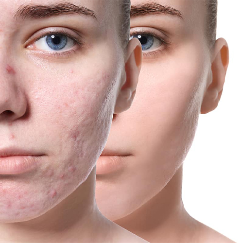 Tìm hiểu về phương pháp Trị mụn bằng laser CO2 Tìm hiểu về phương pháp Trị mụn bằng laser CO2