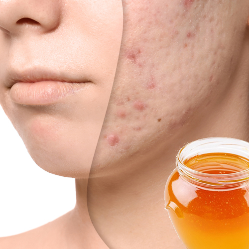 Trị mụn bằng mật ong có hiệu quả không ? Trị mụn bằng mật ong có hiệu quả không ?