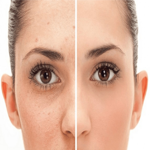 Trị nám bằng laser bao nhiêu tiền ? Trị nám bằng laser bao nhiêu tiền ?