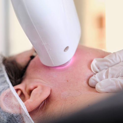 Điều trị nám bằng laser toning hiệu quả thế nào Điều trị nám bằng laser toning hiệu quả thế nào