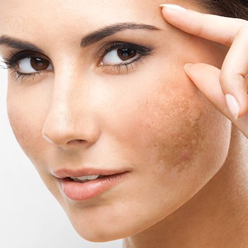 Điều trị nám bằng laser toning hiệu quả thế nào Điều trị nám bằng laser toning hiệu quả thế nào