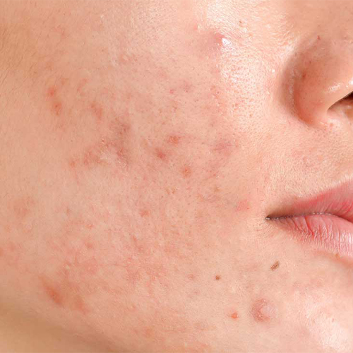 Các biện pháp trị sẹo mụn tại nhà hiệu quả Các biện pháp trị sẹo mụn tại nhà hiệu quả