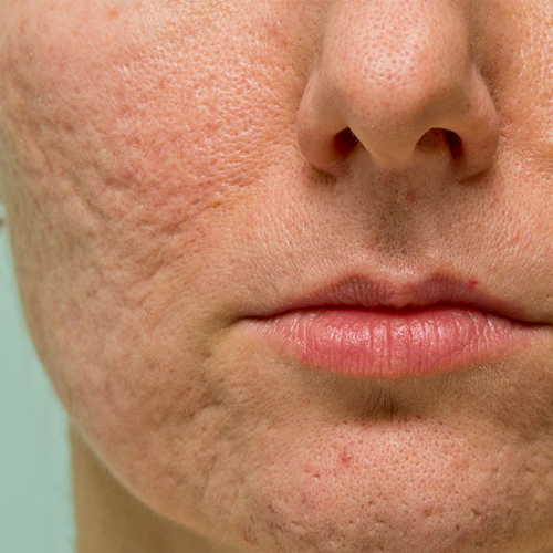 Trị sẹo rỗ bằng phương pháp tự nhiên Trị sẹo rỗ bằng phương pháp tự nhiên