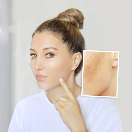 Các phương pháp xóa sẹo thâm tốt nhất Các phương pháp xóa sẹo thâm tốt nhất