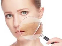 Tạm biệt nám da nhờ ăn uống đúng cách