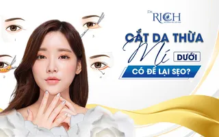Cắt da thừa mí dưới có để lại sẹo?