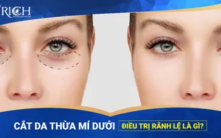 Cắt da thừa mí dưới điều trị rãnh lệ là gì?