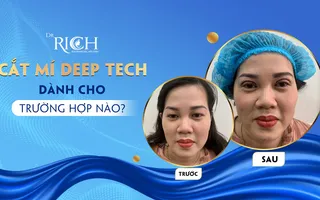 Cắt mí Deep Tech dành cho trường hợp nào?