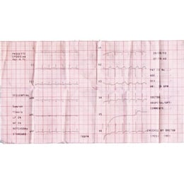 Giấy điện tim dùng cho máy đo điện tim 3/6 Kênh 110mm x 20m