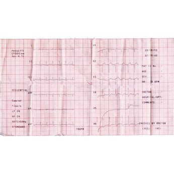 Giấy điện tim dùng cho máy đo điện tim 3/6 Kênh 110mm x 20m