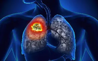 Liệu pháp nhắm mục tiêu trong điều trị Ung thư phổi không tế bào nhỏ (NSCLC) dương tính với EGFR Liệu pháp nhắm mục tiêu trong điều trị Ung thư phổi không tế bào nhỏ (NSCLC) dương tính với EGFR