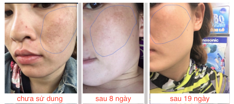 kem trị nám tàn nhang Nacos Hàn Quốc giá bao nhiêu