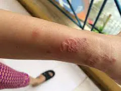 Cách hiệu quả loại bỏ ký sinh trùng trong cơ thể bạn